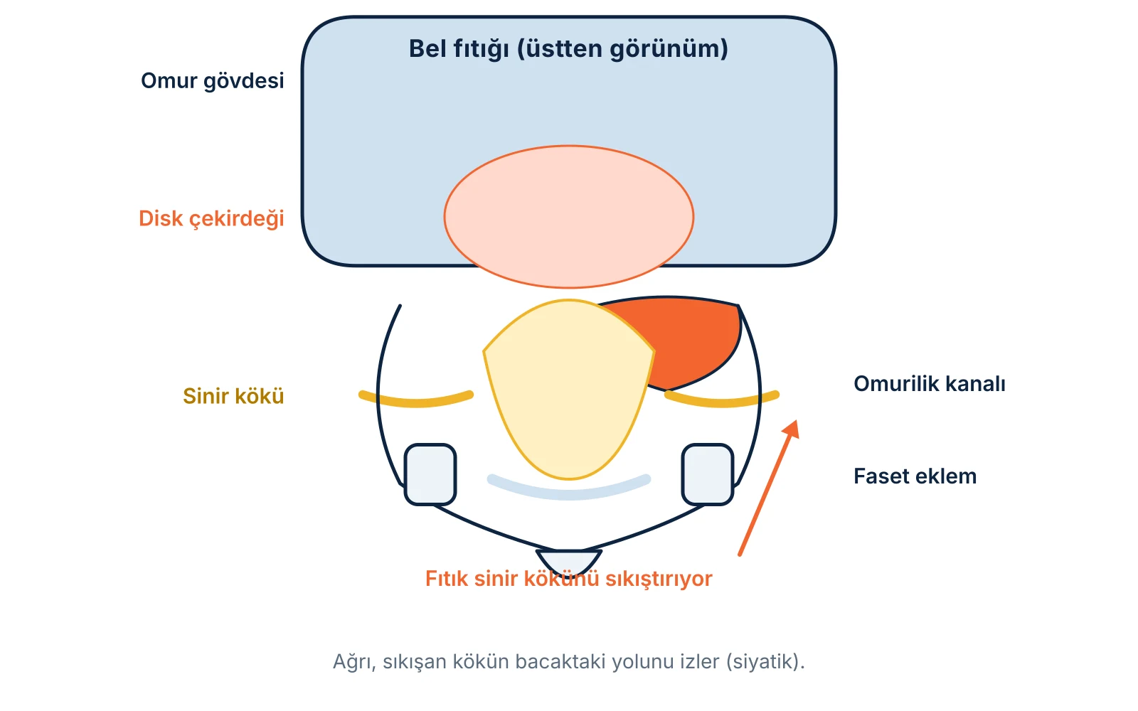 Bel fıtığı: üstten kesitte disk parçasının sinir köküne baskısı