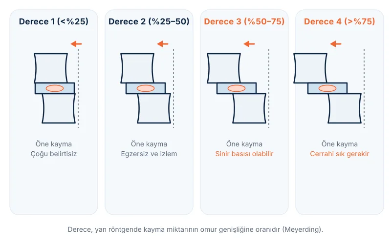 Bel kayması (spondilolistezis) dereceleri: üst omurun alttakine göre öne kayma oranı