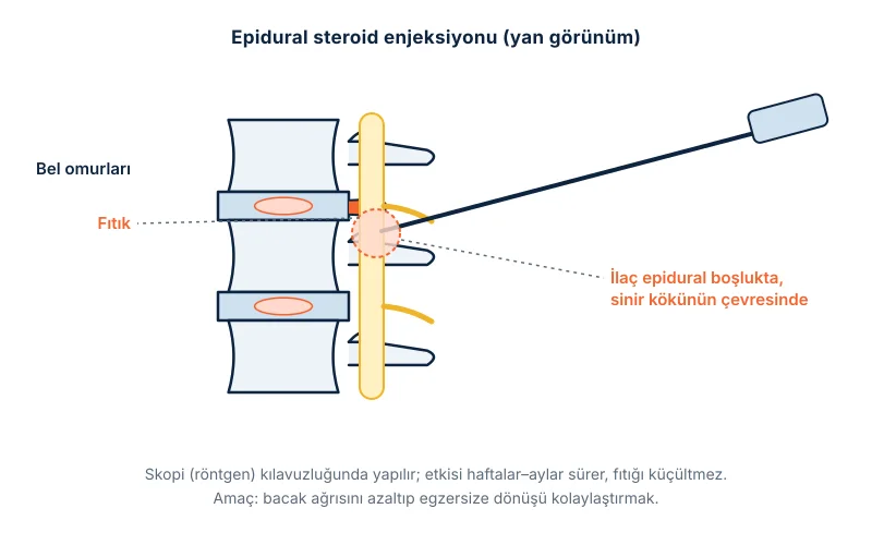 Epidural steroid enjeksiyonu: iğnenin omurilik zarının dışındaki boşluğa, sinir kökünün yanına ulaşması