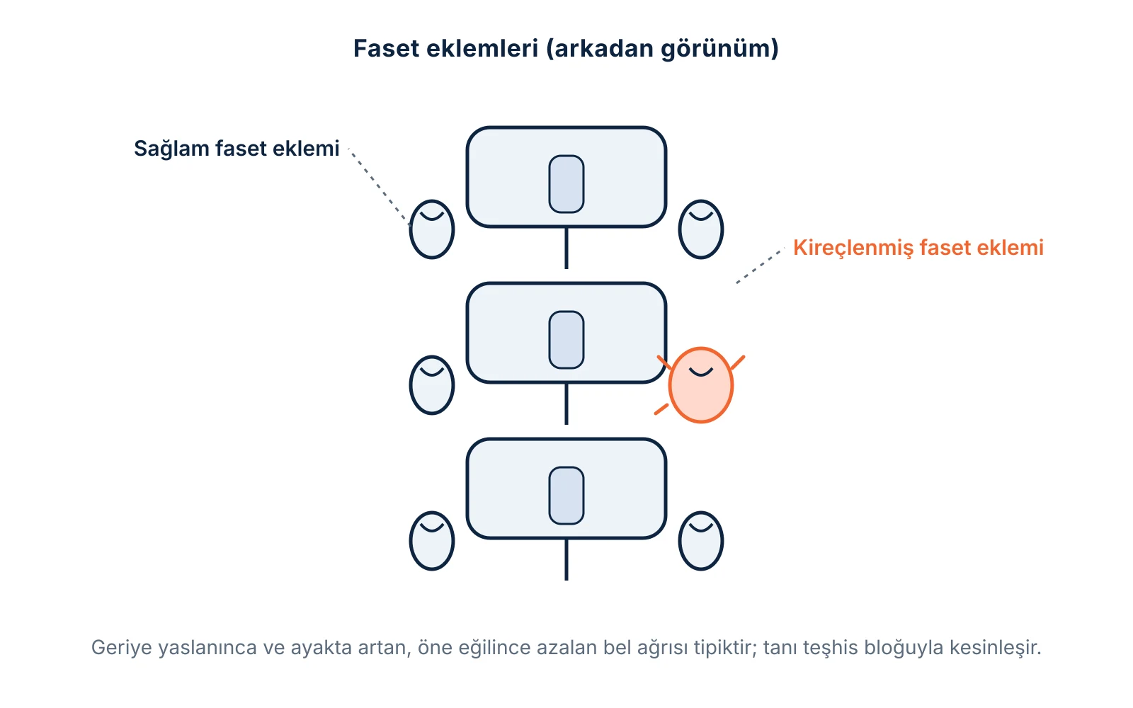 Faset eklemleri: omurların arkasındaki küçük eklemler ve kireçlenmesi