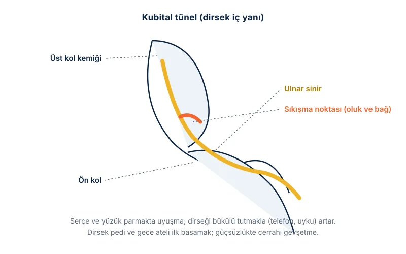 Kubital tünel: dirseğin iç yanında ulnar sinirin kemik oluğunda sıkışması