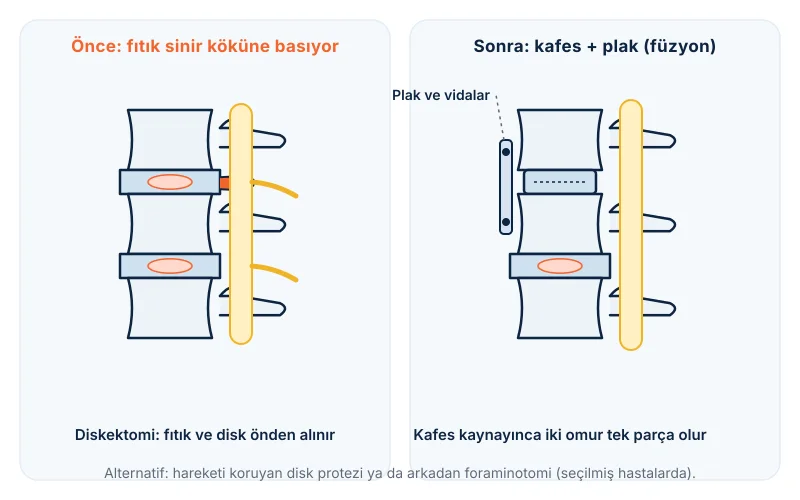 Boyun fıtığında önden diskektomi ve füzyon (ACDF): diskin alınıp yerine kafes ve plak konması