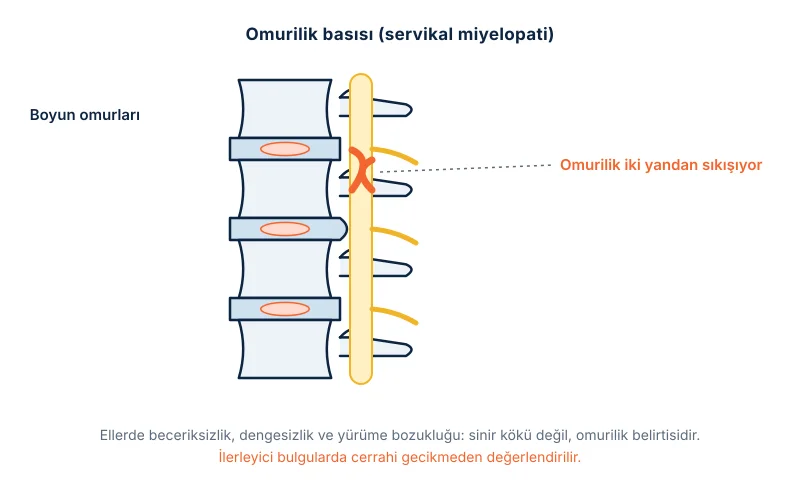 Servikal miyelopati: boyunda kemik ve disk çıkıntılarının omuriliği sıkıştırması
